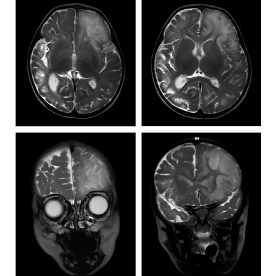 hyperornithinemia hyperammonemia homocitrullinuria (hhh ) syndrome test